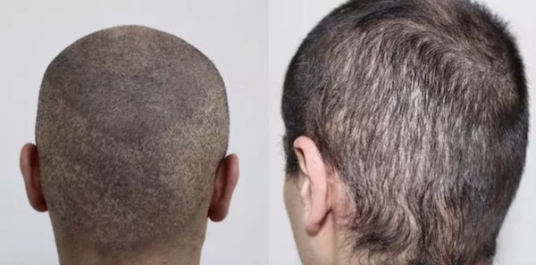 Risiken einer Haartransplantation – Beispiel für misslungenen Eingriff