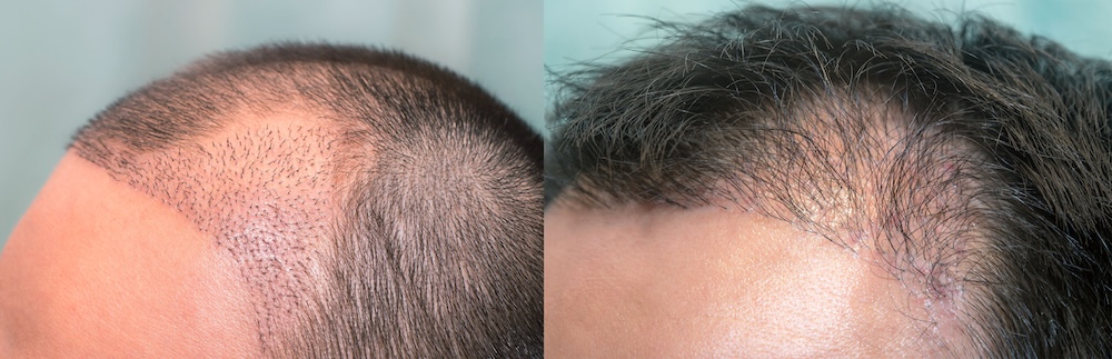 Beispiel einer unnatürlichen Haarlinie nach misslungener Haartransplantation