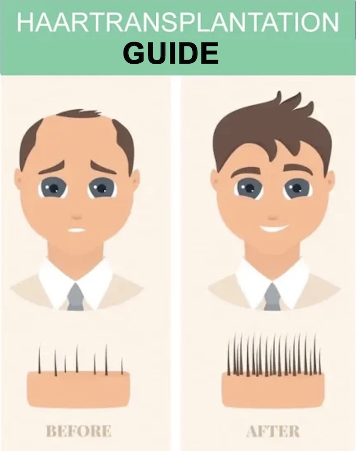 Der große Haartransplantation-Guide von Hairforlife