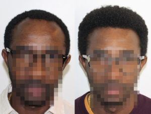 FUE Haartransplantation Entnahme schwieriger bei Locken Bild Follikel krausige Haare - Resultat-Beispiel