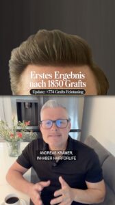 Haartransplantation Haarlinien Finetuning nach gutem Resultat Dr. Heitmann Zürich, Schweiz