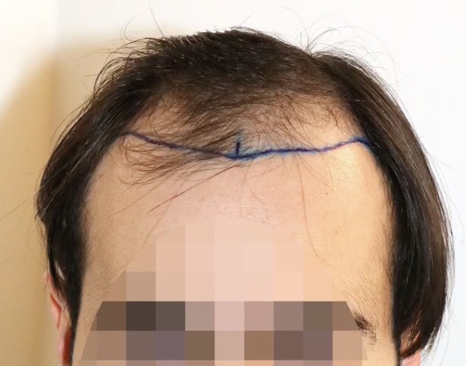 Fortgeschrittener Haarausfall NW5A und NW6 bei der langfristigen Planung einer Haartransplantation