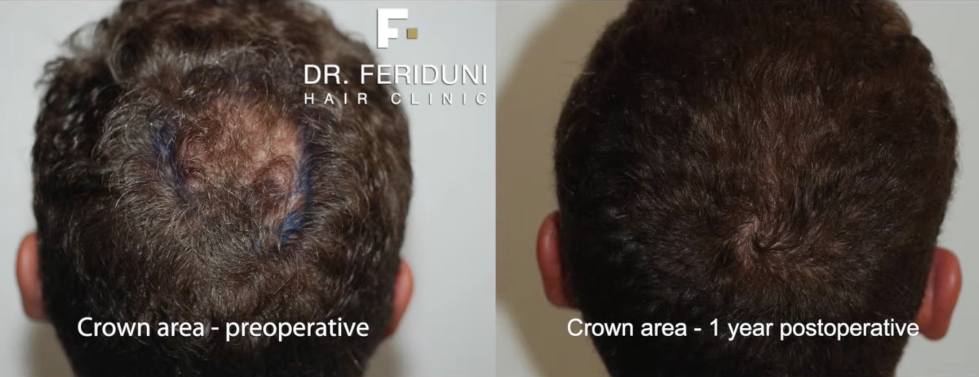 Haartransplantation Tonsur Vorher Nachher mit 1408 Grafts