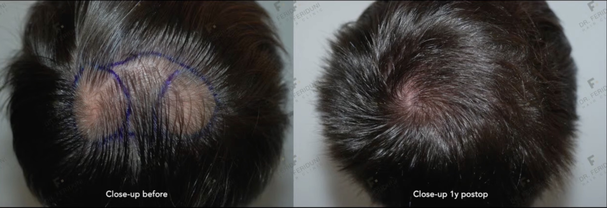 Haartransplantation Tonsur Vorher Nachher mit 1486 Grafts
