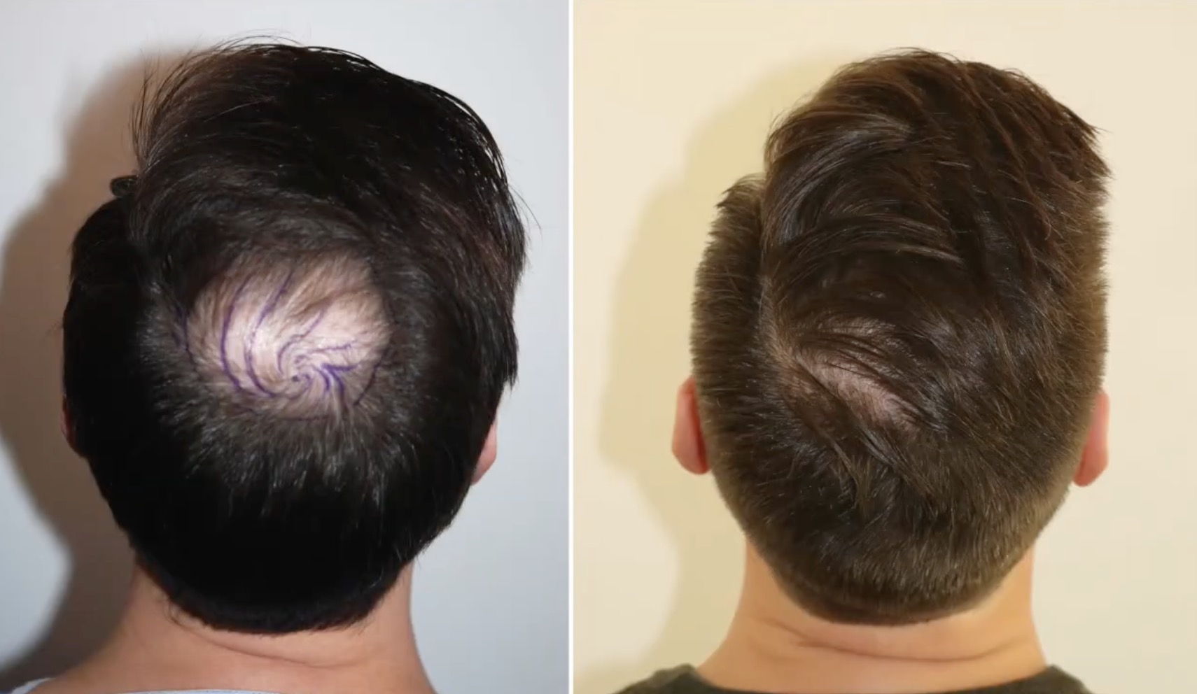 Haartransplantation Tonsur Vorher Nachher mit 1906 Grafts