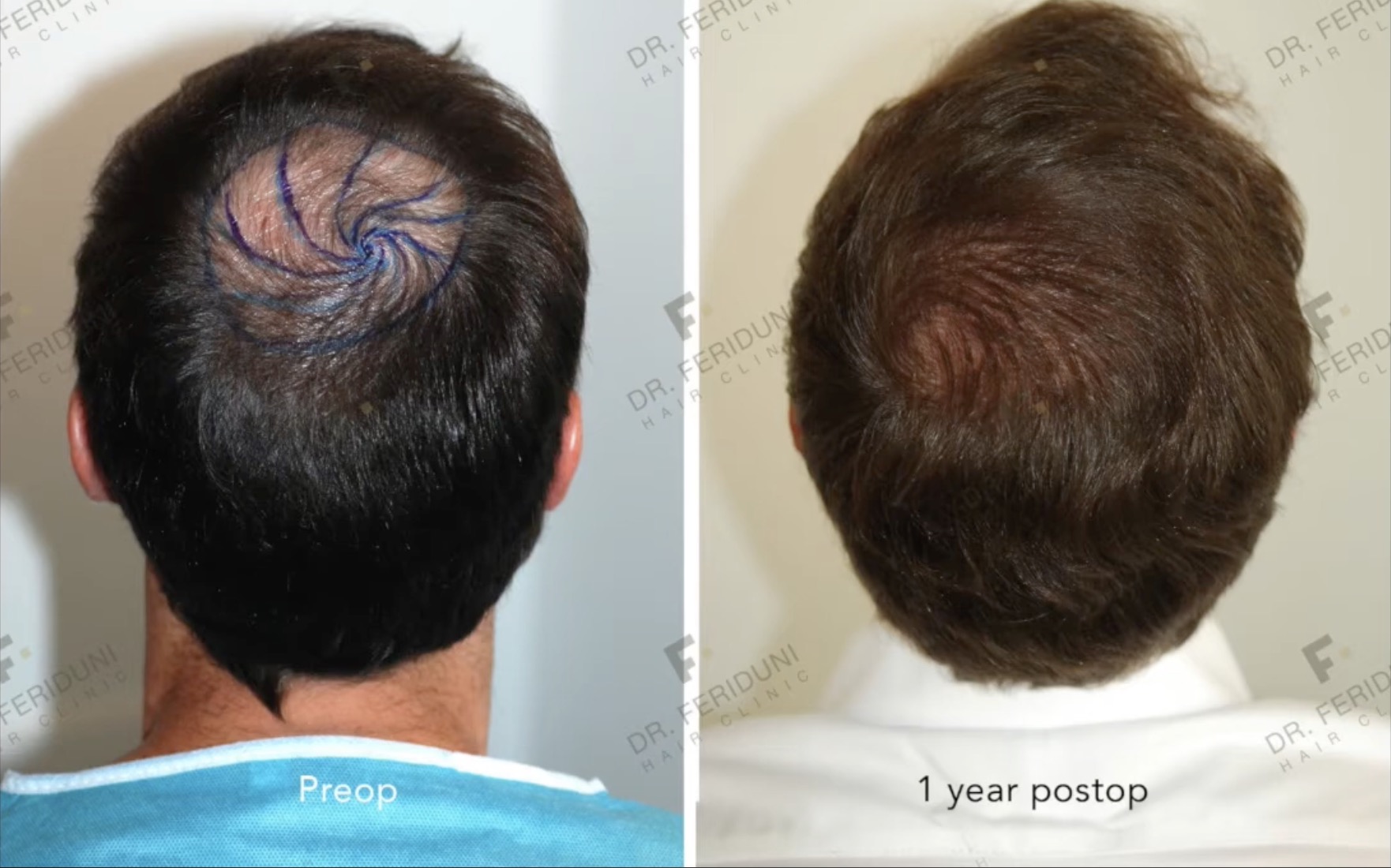 Haartransplantation Tonsur Vorher Nachher mit 2760 Grafts