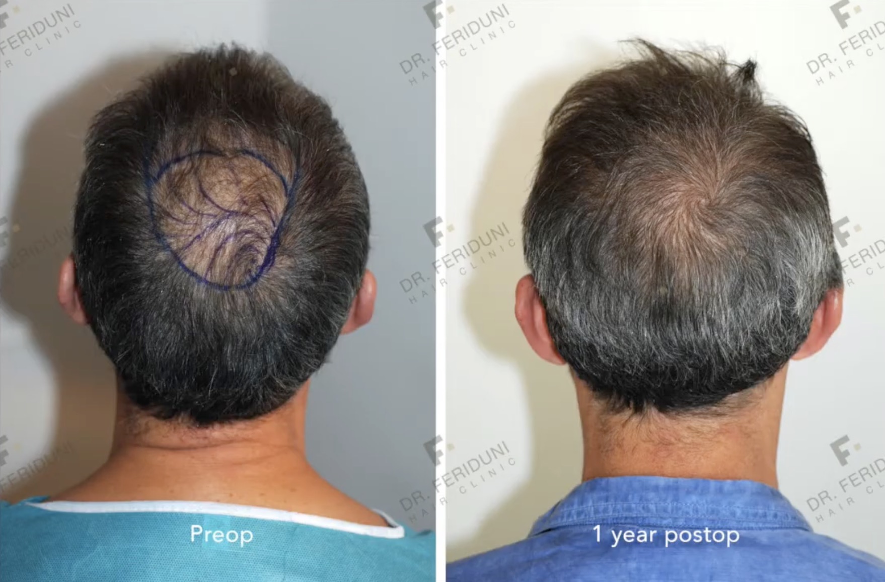 Haartransplantation Tonsur Vorher Nachher mit 763 Grafts