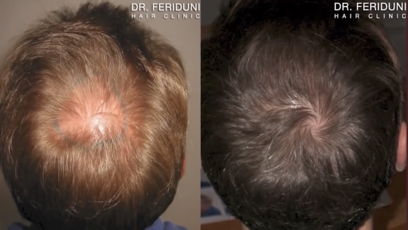 Haartransplantation Tonsur Verdichtung Vorher Nachher mit 1180 Grafts