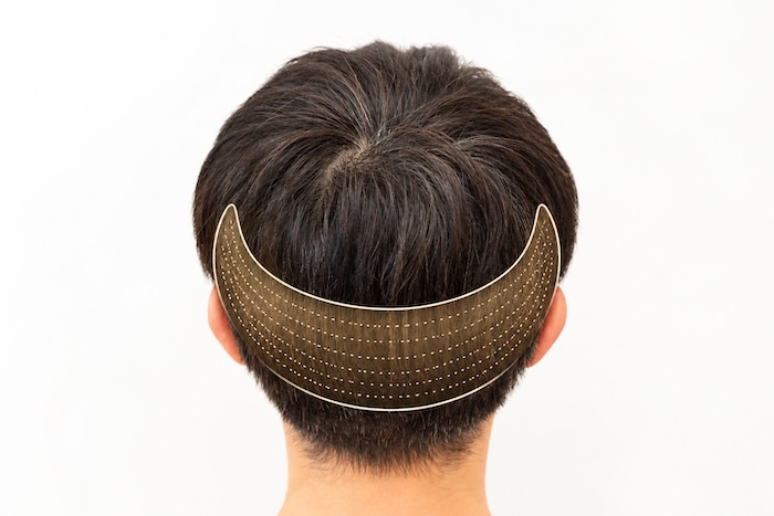 Spenderbereich und Tonsur bei der Planung einer Haartransplantation